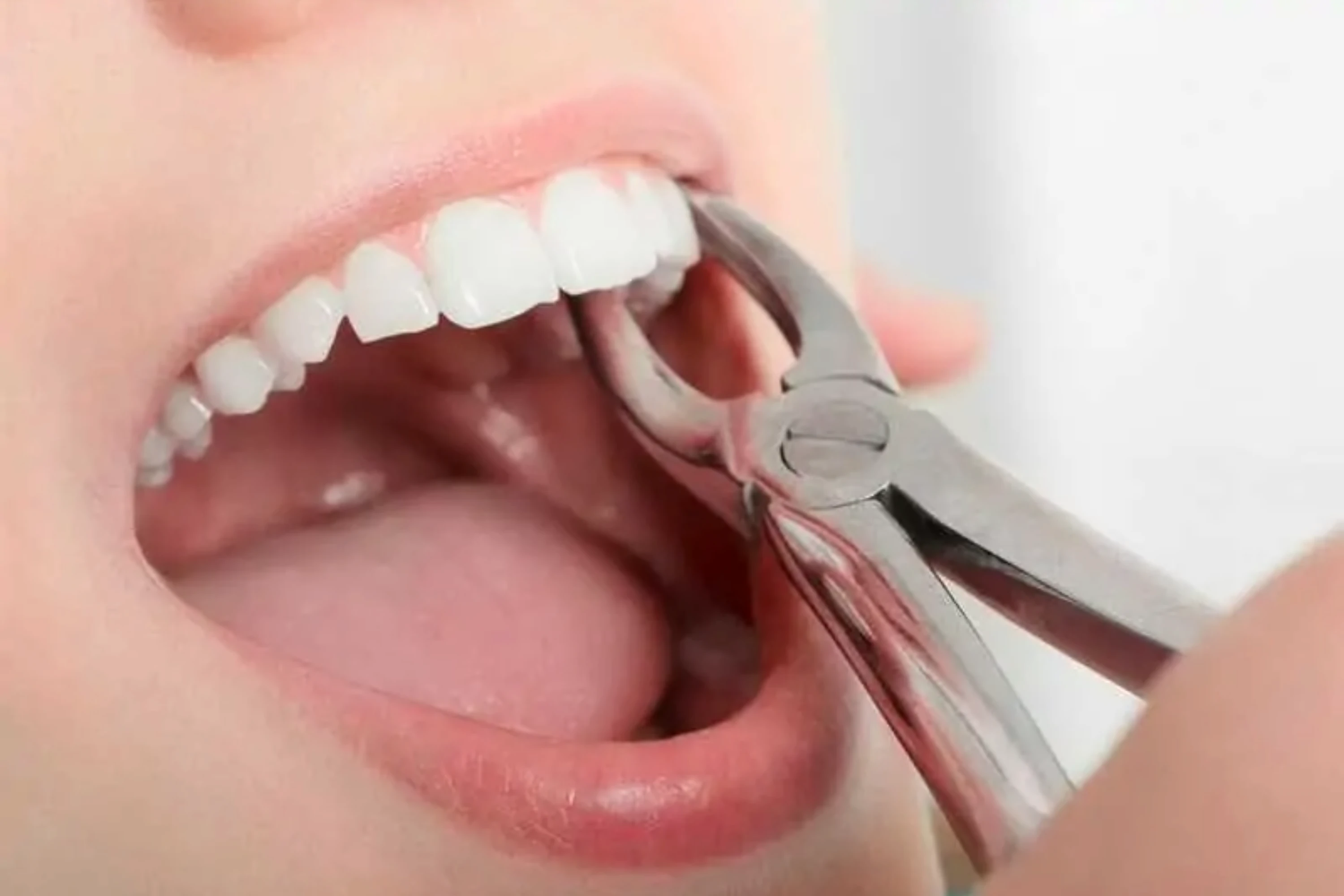 Tooth Extraction in Turkey, Antalya