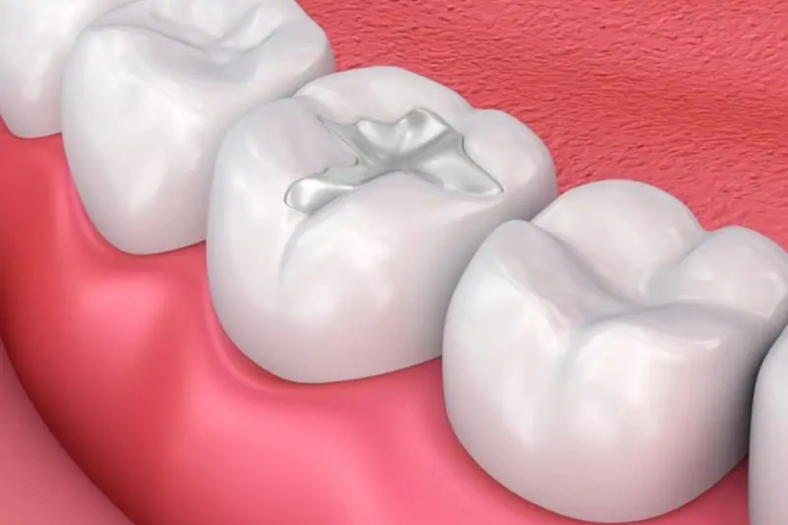 Tooth Filling in Turkey, Antalya